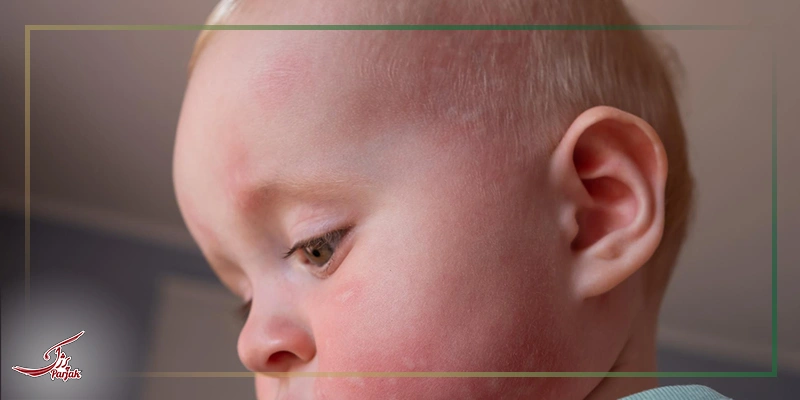 کلاه گهواره یا Cradle cap
