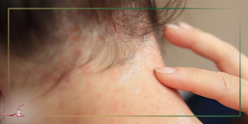درماتیت سبورئیک Seborrheic dermatitis
